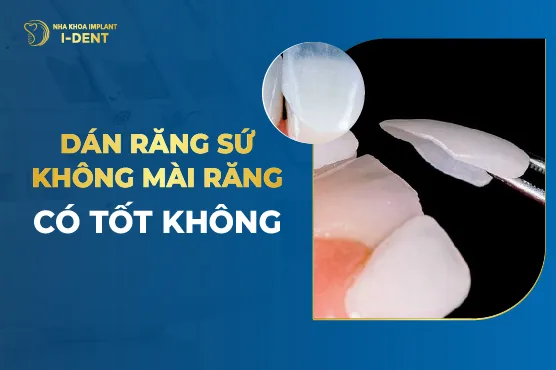 Dán Sứ Không Mài Răng Là Gì? Ưu Nhược Điểm? Giá Bao Nhiêu?