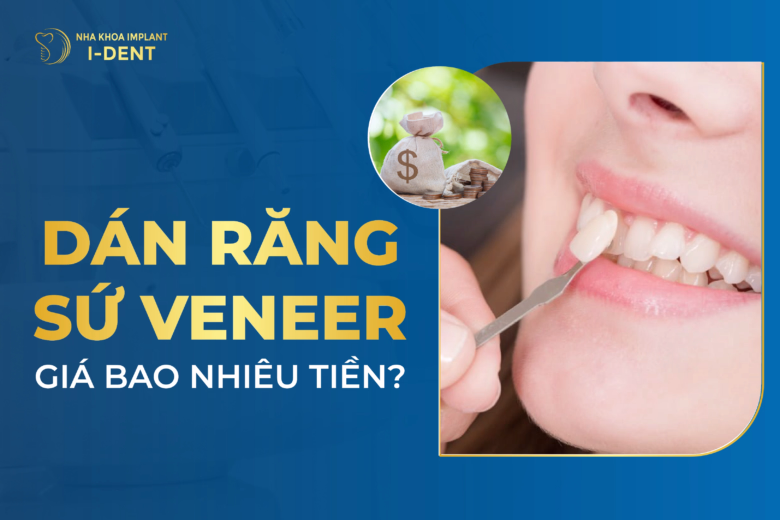Dán Răng Sứ Veneer Giá Bao Nhiêu Tiền