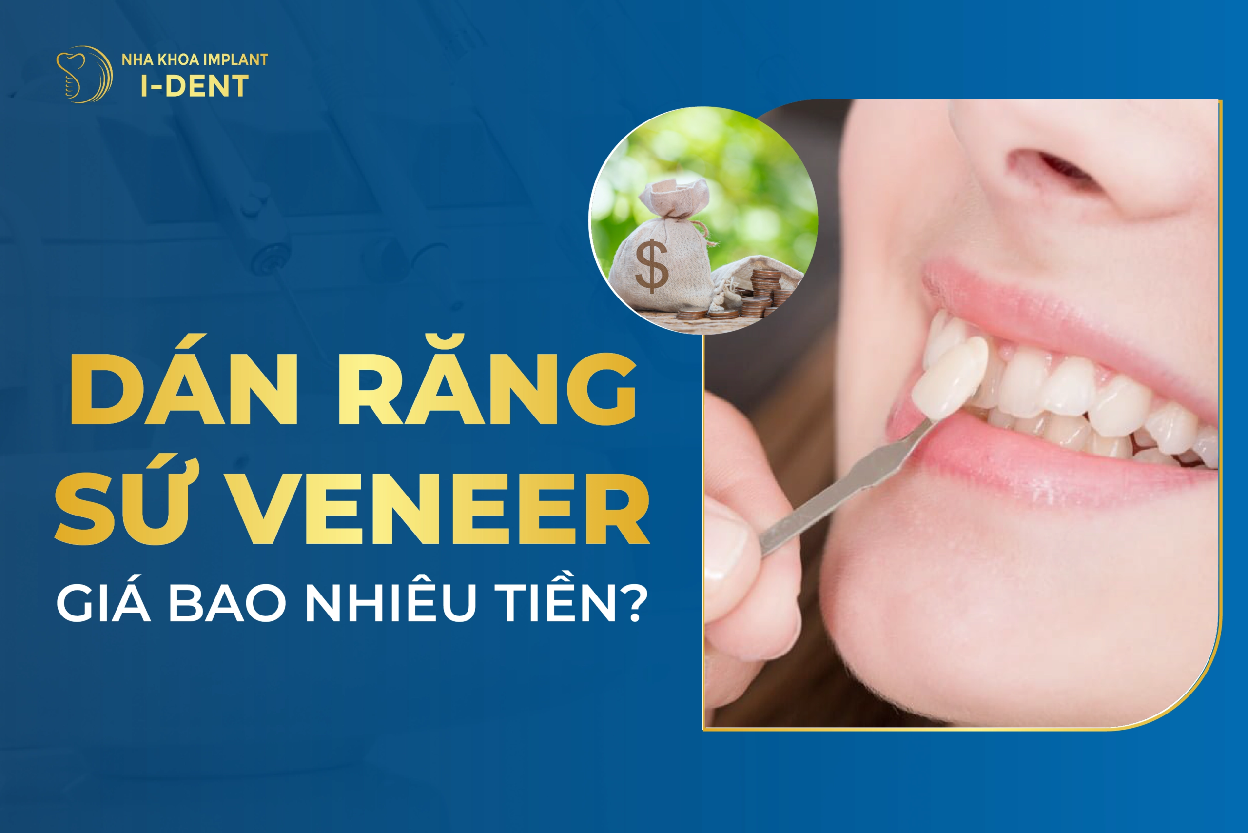 7. Các Câu Hỏi Thường Gặp Về Dán Răng Sứ Veneer