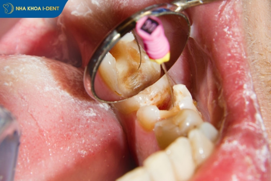 diệt tủy răng có đau không