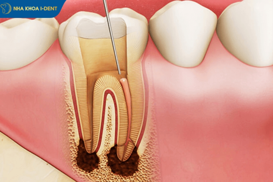 điều trị tủy răng có đau không