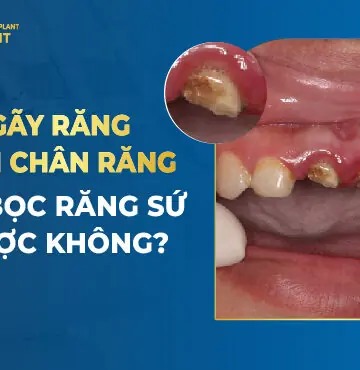 Gãy răng còn chân răng có bọc răng sứ được không?