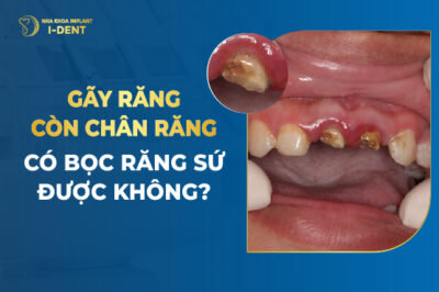 Gãy răng còn chân răng có bọc răng sứ được không?