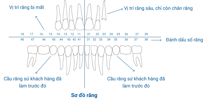 Phác Đồ – Bước 2 – Sơ Đồ Răng