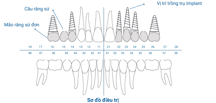 Phác Đồ – Bước 2 – Sơ Đồ Điều Trị