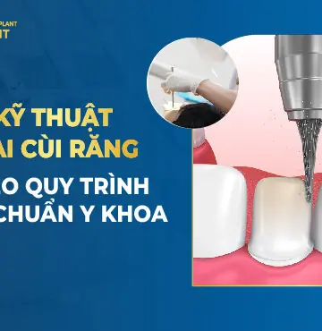 Kỹ Thuật Mài Cùi Răng Theo Quy Trình Đạt Chuẩn Y Khoa