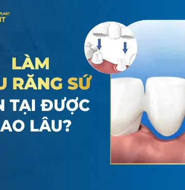 Làm Cầu Răng Sứ Tồn Tại Được Bao Lâu?