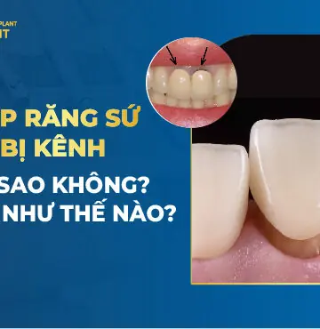 Lắp Răng Sứ Bị Kênh Có Sao Không? Xử Lý Như Thế Nào?