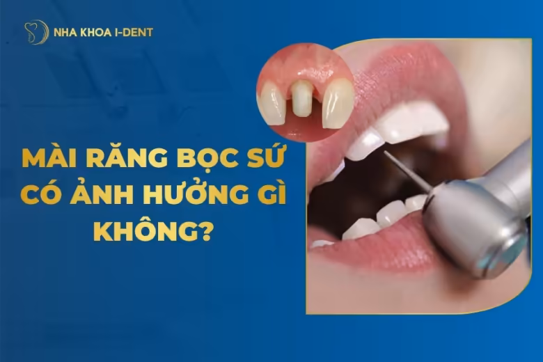 mài răng bọc sứ