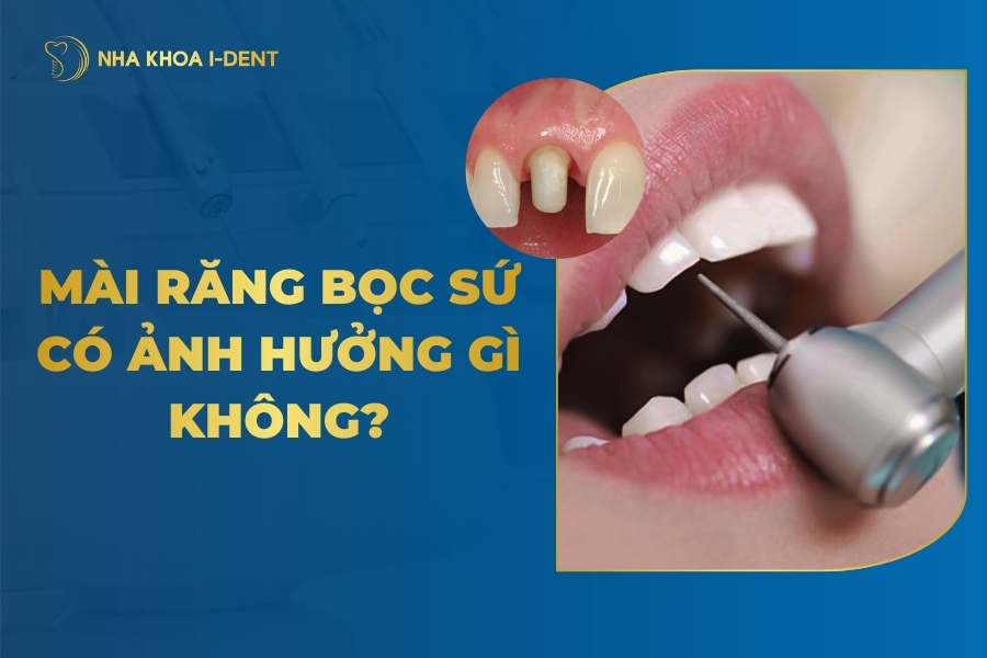 Có Nên Mài Răng Bọc Sứ Không? Tác Hại Lưu Ý