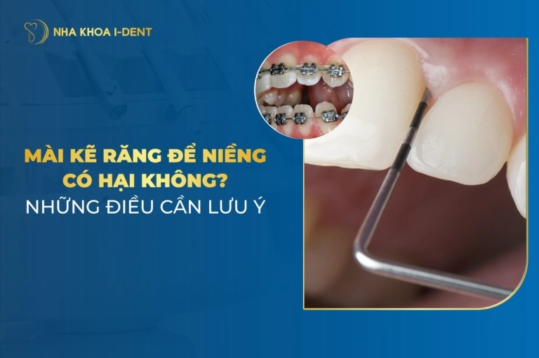 Mài Kẽ Răng Khi Niềng Có Ảnh Hưởng Gì Không? Lưu Ý