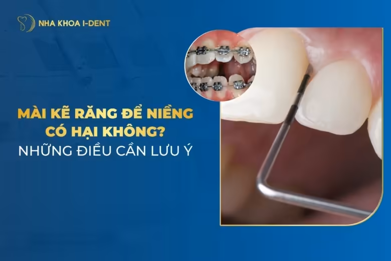 Mài Kẽ Răng Khi Niềng Có Ảnh Hưởng Gì Không? Lưu Ý