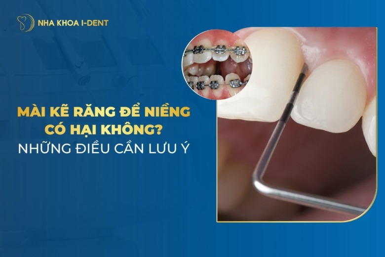Mài Kẽ Răng Để Niềng Có Hại Không? Những Điều Cần Lưu Ý