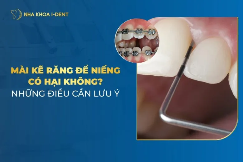 Mài Kẽ Răng Khi Niềng Có Ảnh Hưởng Gì Không? Lưu Ý