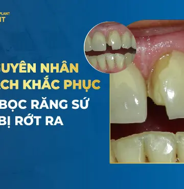 Bọc Răng Sứ Có Bị Rớt Ra Không? Cách Xử Lý