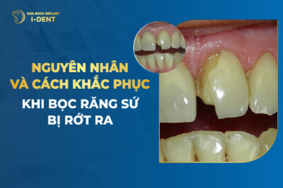 Bọc Răng Sứ Có Bị Rớt Ra Không? Cách Xử Lý