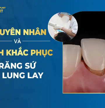 Nguyên Nhân Và Cách Khắc Phục răng Sứ Bị Lung Lay