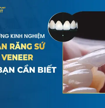 Những Kinh Nghiệm Dán Răng Sứ Veneer Mà Bạn Cần Biết