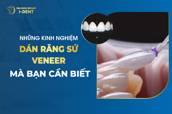 Những Kinh Nghiệm Dán Răng Sứ Veneer Mà Bạn Cần Biết