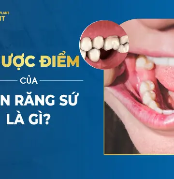 Ưu Nhược Điểm Của Dán Sứ Veneer Là Gì? Có Tốt Không?