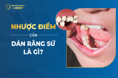 Ưu Nhược Điểm Của Dán Sứ Veneer Là Gì? Có Tốt Không?