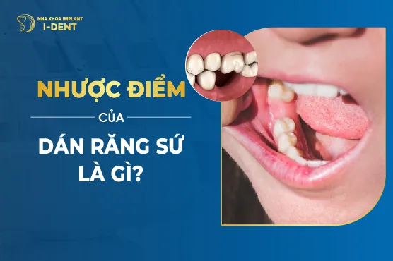 Ưu Nhược Điểm Của Dán Sứ Veneer Là Gì? Có Tốt Không?