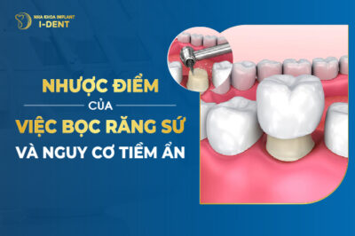 Nhược Điểm Của Việc Bọc Răng Sứ? Cân Nhắc Gì Khi Làm?