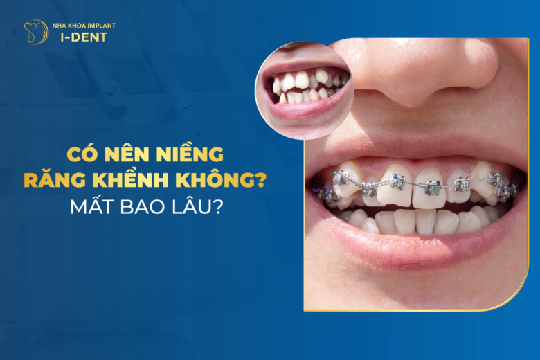 niềng răng khểnh
