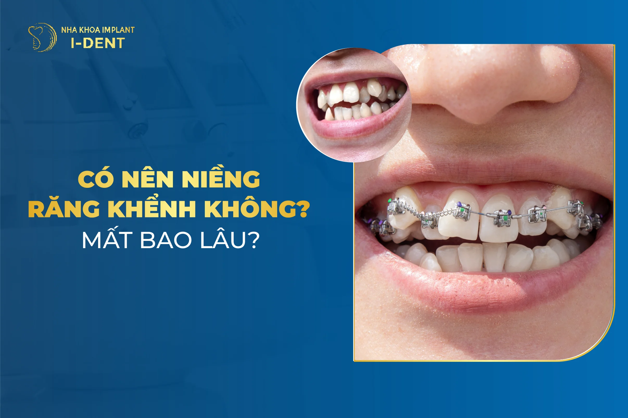 Có Nên Niềng Răng Khểnh Không?