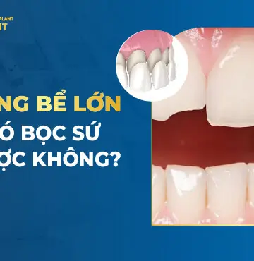 Răng Bể Lớn Có Bọc Sứ Được Không?