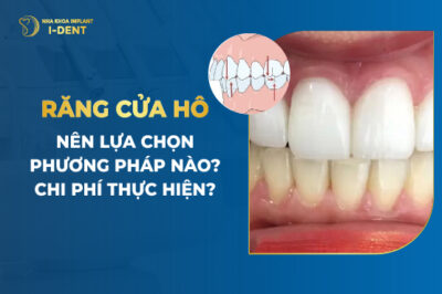Răng cửa hô nên lựa chọn phương pháp nào? Chi phí thực hiện?