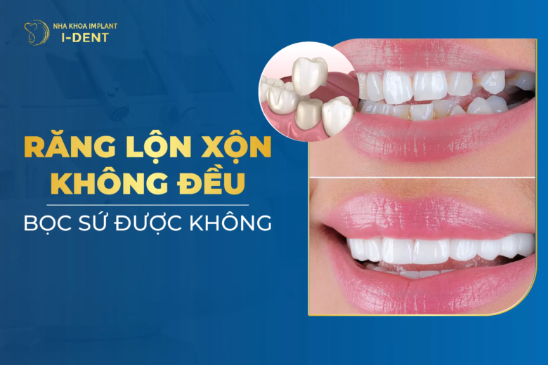Răng Lộn Xộn Không Đều Có Bọc Sứ Được Không?