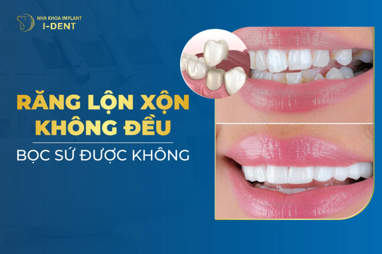 Răng Mọc Lệch Lộn Xộn Có Bọc Sứ Được Không?