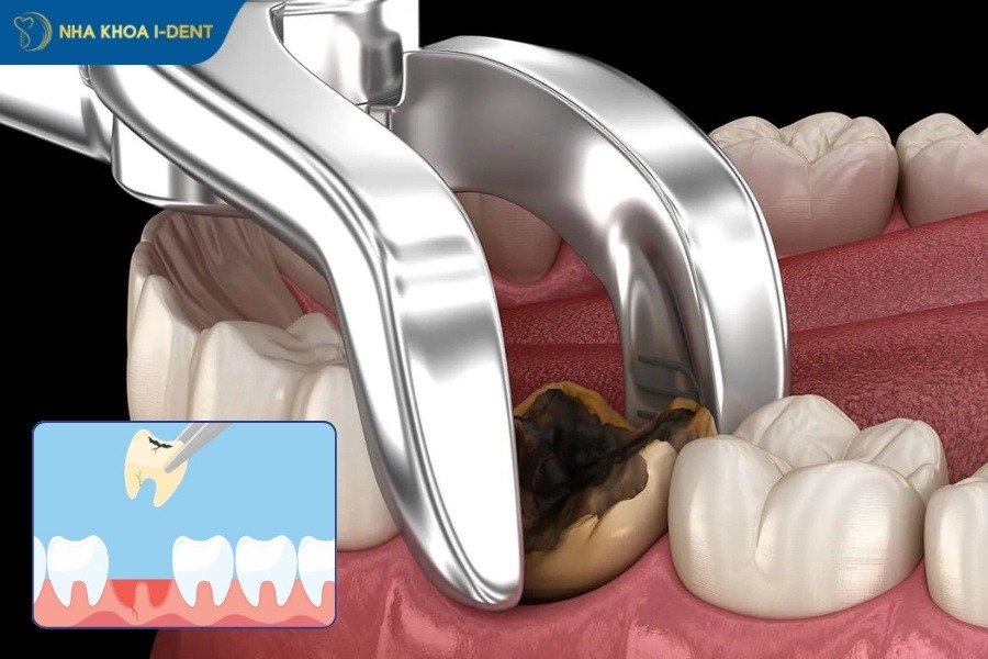 răng sâu có nên nhổ không