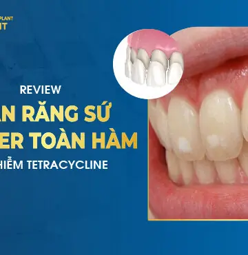 Review Dán Răng Sứ Veneer Toàn Hàm Bị Nhiễm Tetracycline