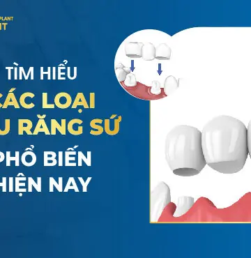 Tìm Hiểu Các Loại Cầu Răng Sứ Phổ Biến Hiện Nay