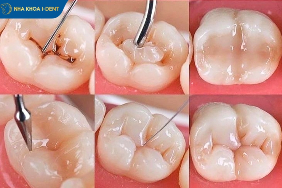 Trám răng sâu bằng vật liệu Composite.