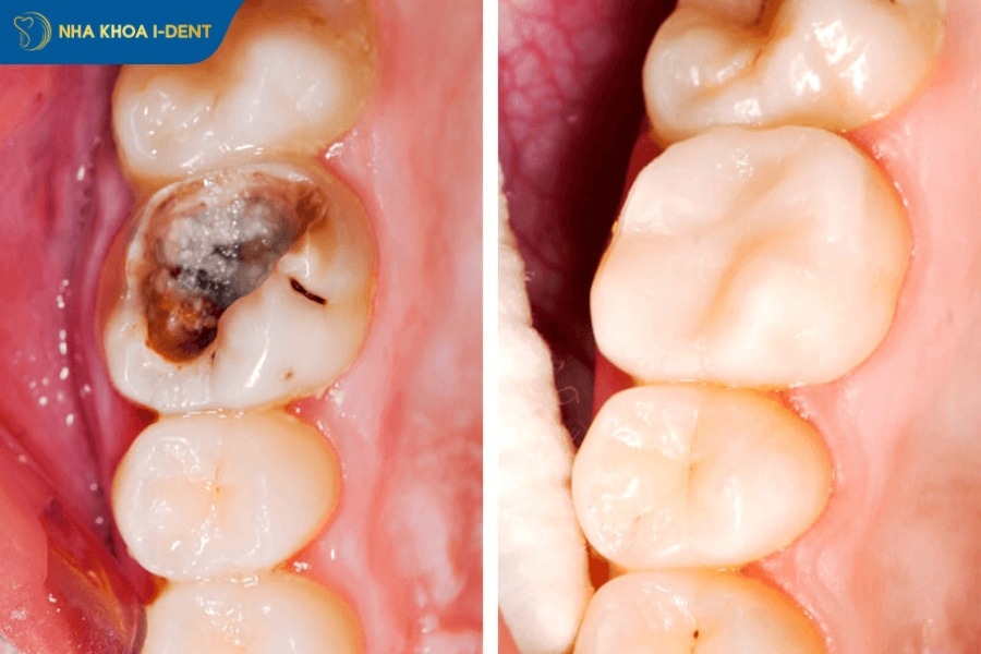 trám răng xong có đau không