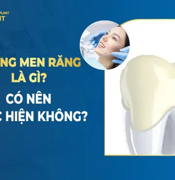 Tráng Men Răng Là Gì? Có Nên Thực Hiện Không?
