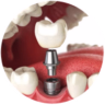 Dịch vụ trồng răng implant tại nha khoa I-Dent.