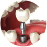 Dịch vụ trồng răng implant tại nha khoa I-Dent.