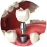 Dịch vụ trồng răng implant tại nha khoa I-Dent.