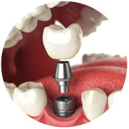 Dịch vụ trồng răng implant tại nha khoa I-Dent.