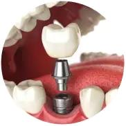 Dịch vụ trồng răng implant tại nha khoa I-Dent.