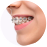Dịch vụ niềng răng chỉnh nha tại nha khoa I-Dent.