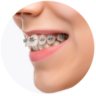 Dịch vụ niềng răng chỉnh nha tại nha khoa I-Dent.