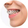 Dịch vụ niềng răng chỉnh nha tại nha khoa I-Dent.