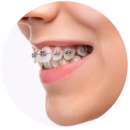 Dịch vụ niềng răng chỉnh nha tại nha khoa I-Dent.