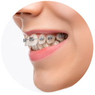Dịch vụ niềng răng chỉnh nha tại nha khoa I-Dent.