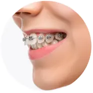 Dịch vụ niềng răng chỉnh nha tại nha khoa I-Dent.